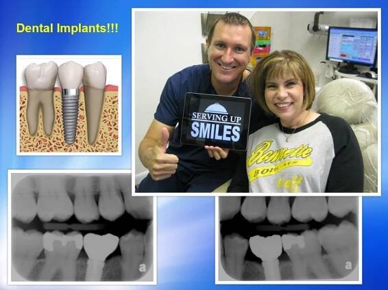 Tooth implant Pasadena TX