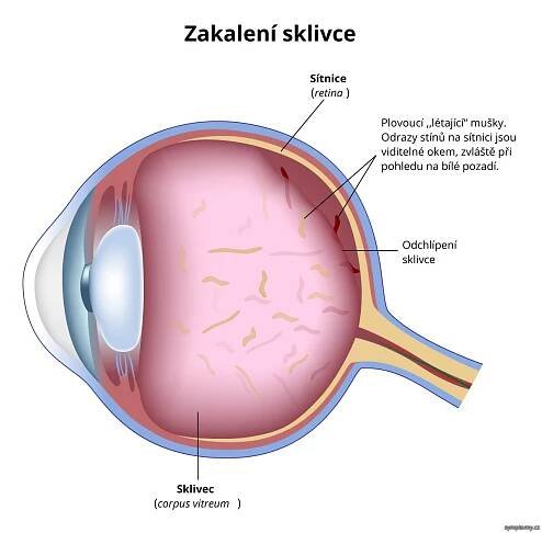 Zakalení sklivce