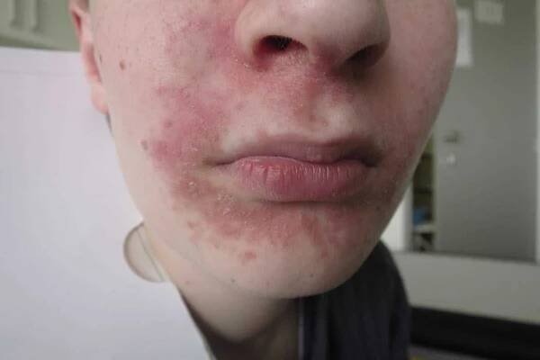 Krupice na obličeji: příčiny, příznaky a léčba