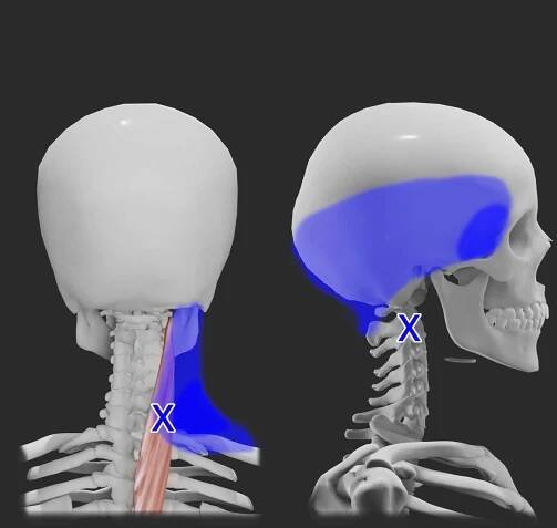Splenius Cervicis Trigger Points