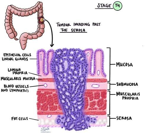 Adenokarcinom tlustého střeva patologický nádor stadia T4