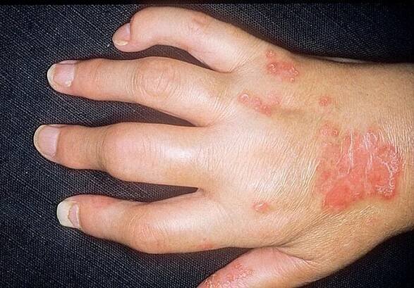 Psoriáza