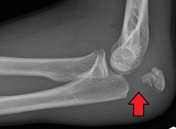 Olecranon fracture - Wikipedia