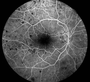 iCare EIDON FA Fluorescein Angiography Confocal Fundus Imaging System