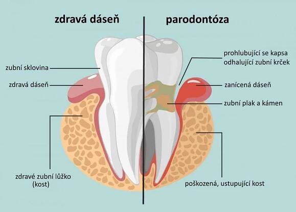 Odhalený krček zubu: příčiny, příznaky a léčba - Srpen 2025 - LaskaVezrozeni.CZ