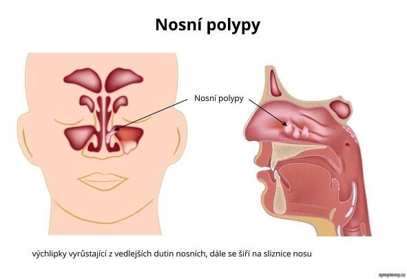 Nosní polypy - příznaky a léčba