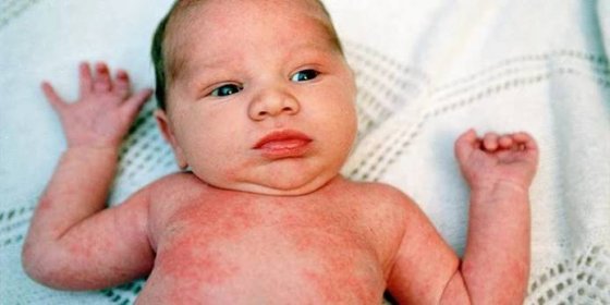 Alergická vyrážka u dieťaťa