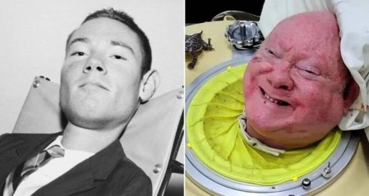 The Inspiring Story Of Paul Alexander, The Man Who Lived In An Iron Lung For 72 Years