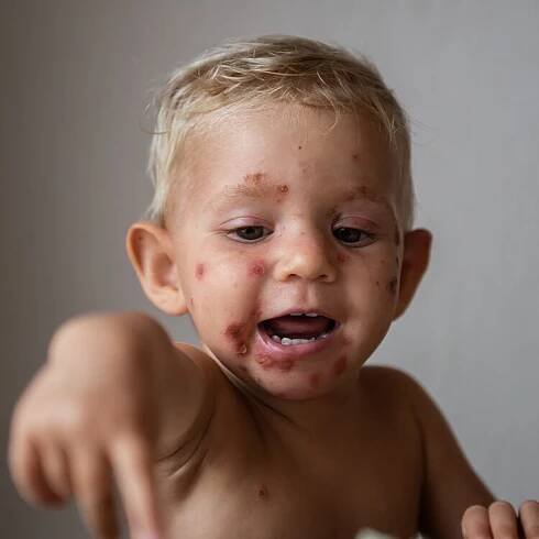 Impetigo – co dělat s nakažlivou bakteriální infekcí kůže? | BENU.cz 
