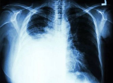 Obraz pleurální výpotek v důsledku rakoviny plic