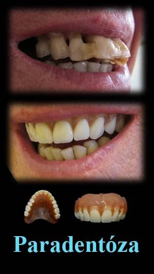 Zhotovení nové zubní náhrady s přihlédnutím k fotografiím situace před extrakcí zubů-rekonstrukce. | LPdental.cz