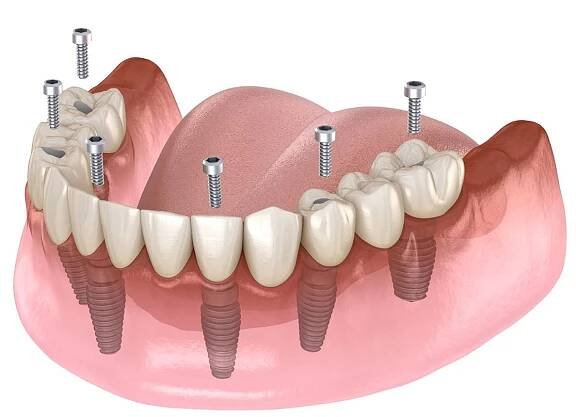 Kdy jsou zubní implantáty vhodné - 3. Náhrada mnoha chybějících zubů