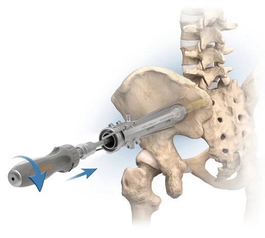 Medical Illustration | Certified Medical Illustrator - Orthopedic Illustration