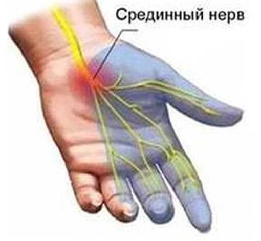 Neuropatie středního nervu / Neuropatie
