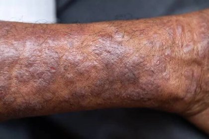 Fyzické Atopická dermatitida (AD), také známý jako atopický ekzém, je typ zánětu kůže (dermatitida). — Stock obrázek