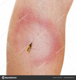 Komár a Erythema Migrans vyrážka.