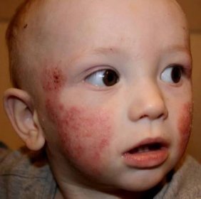 Jak vypadá herpes u dítěte? 13 fotografií na těle, krku a obličeji, rtech, rukou, nohou a nose u novorozenců, opasková forma