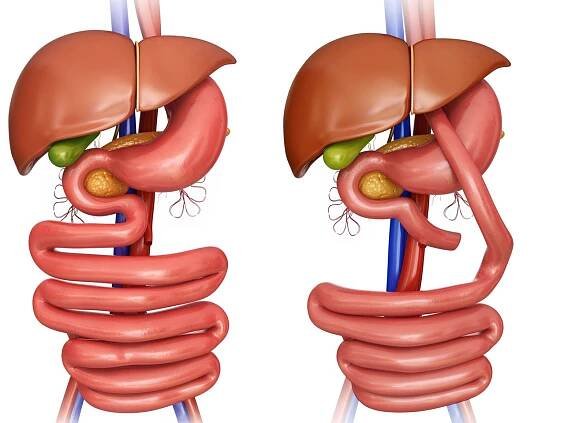 Gastric bypass illustration showing a before and after image of the human digestive system