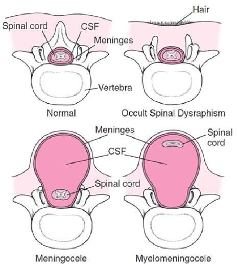 Spina Bifida - Pediatrics - Merck Manual Professional Edition