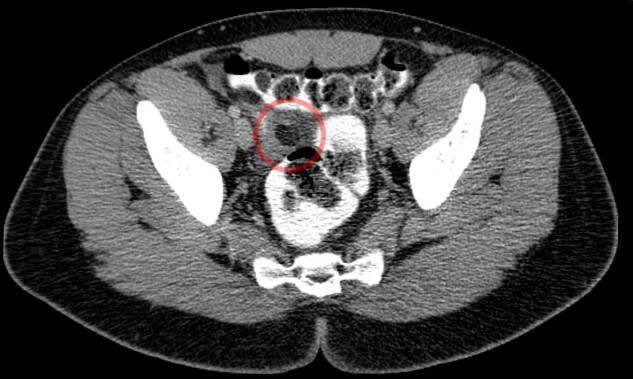 Appendix epiploica
