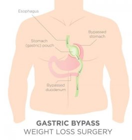Gastric Bypass | HWBazaar