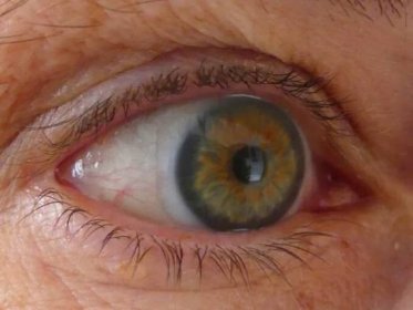 Žena ztratila zrak v jednom oku kvůli nebezpečnému parazitovi
