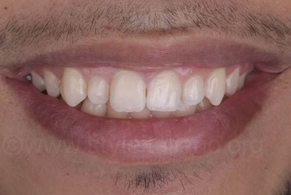 smile after brown spot restoration