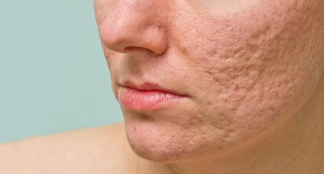 Odstranění jizev a flíčků po akné – SKIN HEALTH kosmetika Praha