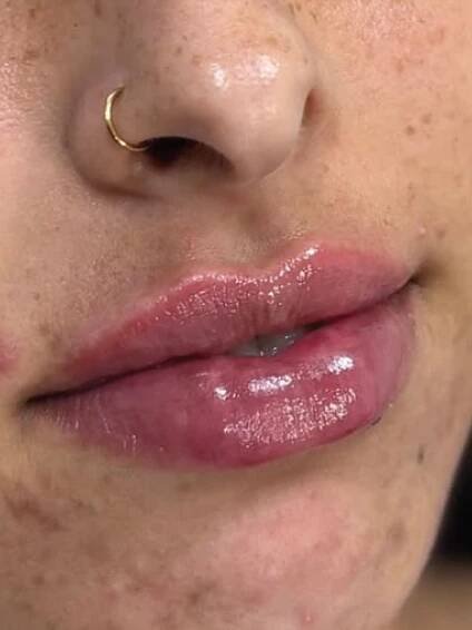 Lip Filler in El Dorado Hills, Sacramento & Rocklin - Esthetics Center