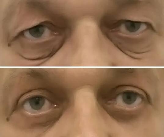 Operace očních víček – foto před a po | Perfect Clinic