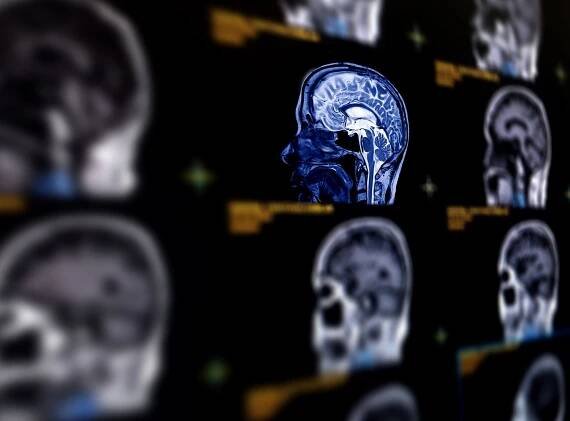 What to Expect If You Have a Brain Aneurysm