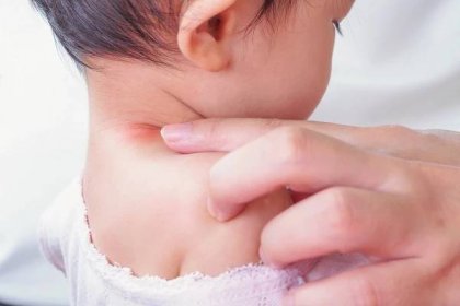 Pásový opar u dětí: Proč vzniká, podle čeho ho poznáte a jak se léčí? |  Canadian Medical