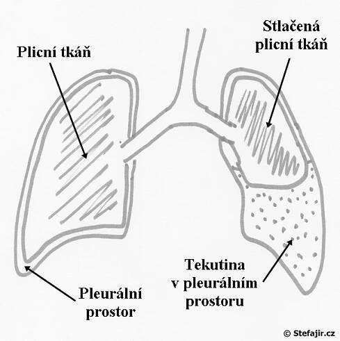 Voda na plicích | Medicína, nemoci, studium na 1. LF UK