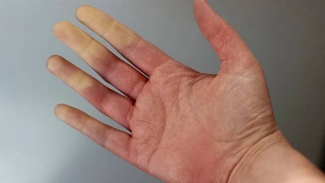 Bělají vám prsty na rukou? Na vině může být Raynaudův syndrom