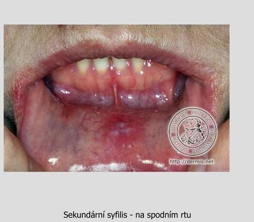 PPT - Pohlavní choroby PowerPoint Presentation, free download - ID:4380095