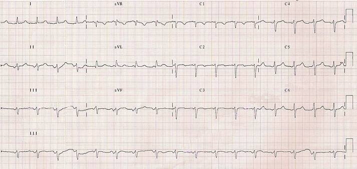 ECG ectopic atrial tachycardia