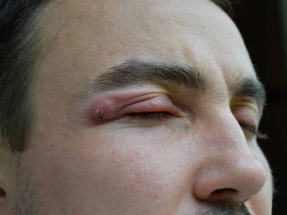 vařit - silný purulentní absces u člověka v blízkosti oka - ječné zrno - stock snímky, obrázky a fotky