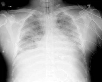 Acute Respiratory Distress Syndrome: Diagnosis and Management | AAFP