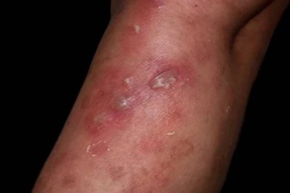 Stafylokoková, streptokoková kožní infekce nebo bulózní impetigo a celulitida v noze asijského pacienta. Izolováno na černé. — Stock obrázek