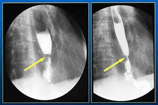 Příznaky a léčba esofagitidy, prevence a možné komplikace / Gastroenterologie | Užitečné informace a tipy na péči o sebe