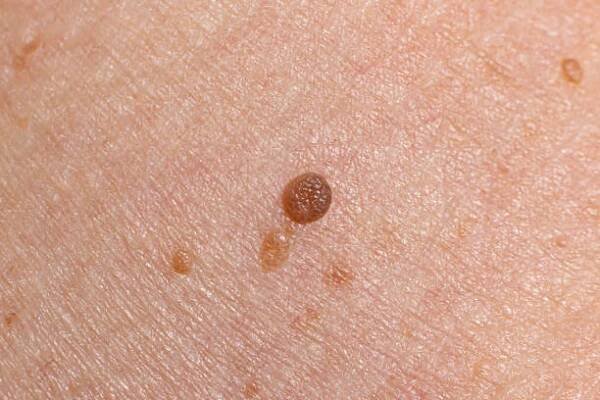 papilom na lidské kůži - benigní nádor ve formě krtek, nevus papillomatosis medicína - bradavicím na chodidle - stock snímky, obrázky a fotky