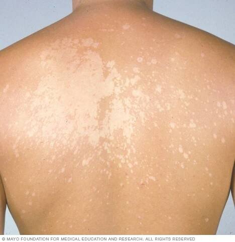 Tinea versicolor 