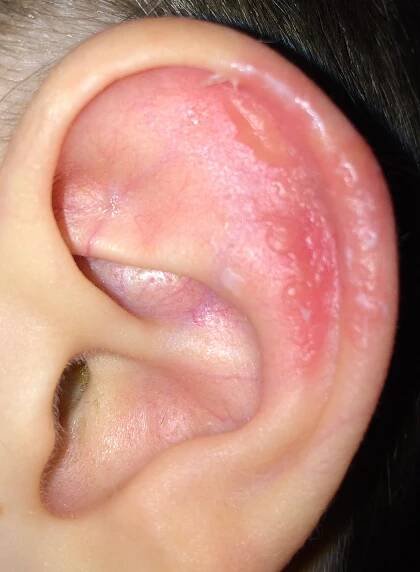 Ear infected with molluscum - Mollenol