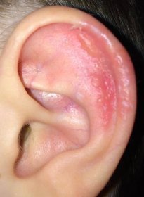 Ear infected with molluscum