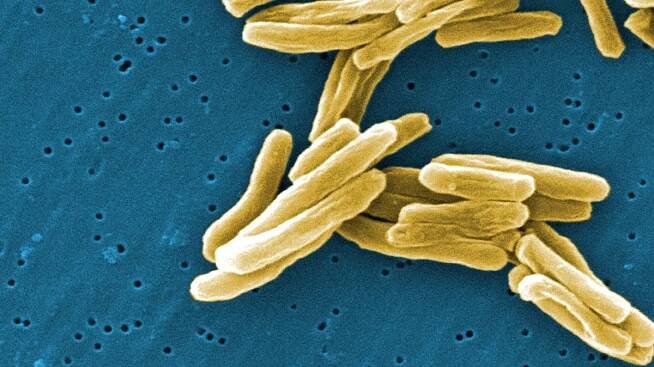 Tuberculosis (TB)