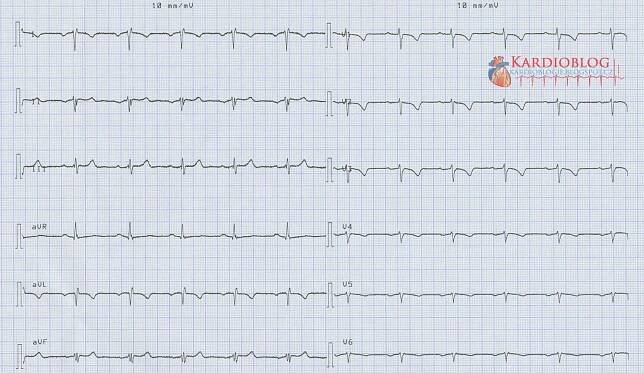 (ZAČÁTEČNÍCI) Prohozené svody na EKG - Kardioblog
