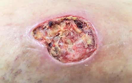 Soubor:Úlcera varicosa (RPS 24-08-2020) en pierna con insuficiencia venosa crónica.png – Wikipedie