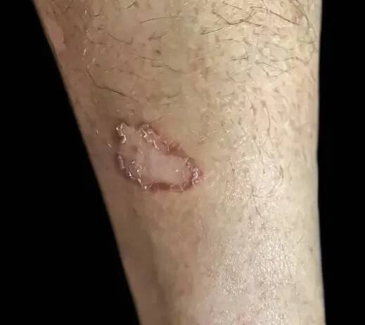 Dermatofytóza, také známá jako Tinea nebo ringworm, plísňová infekce kůže. — Stock obrázek