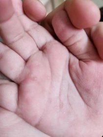Alergie a ekzémy | Puchýřky na rukou a nohou