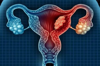 Varovné projevy karcinomu vaječníků, které by měla znát každá žena bez ohledu na věk
